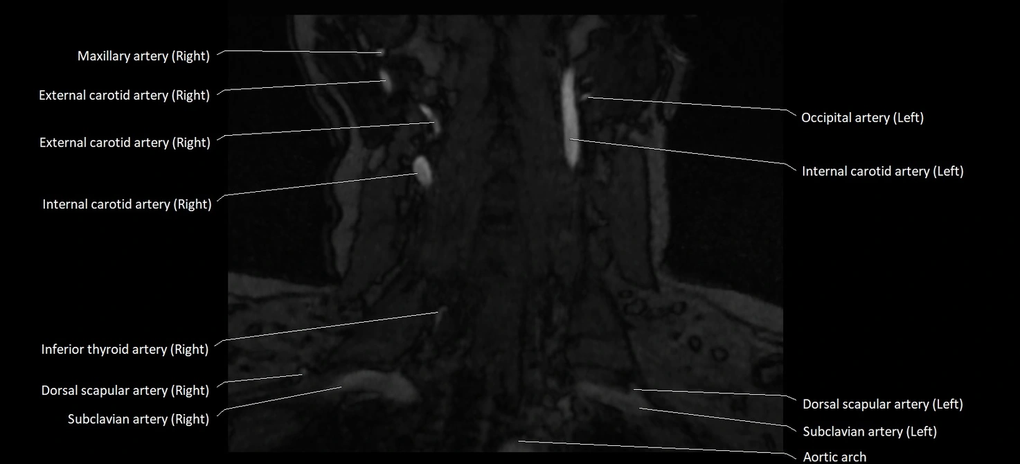 MRA carotid artery anatomy cross sectional 3T coronal image 7.webp